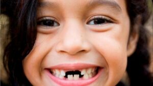 Nằm mơ thấy rụng răng thì có bị làm sao không?